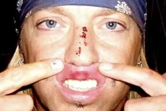 Bret Michaels showed off his injury